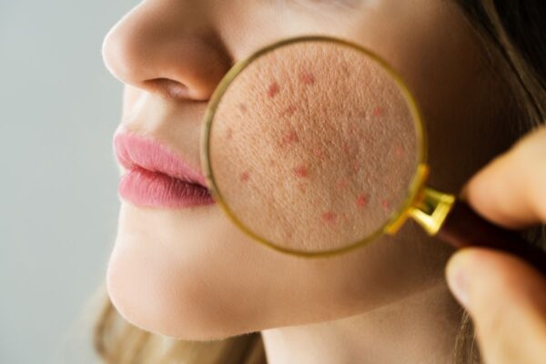 Desvendando os Mistérios da Acne: Causas e Soluções”